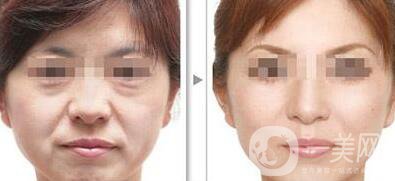 電波拉皮除皺好嗎？*果到底怎么樣