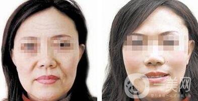 電波拉皮除皺好嗎？*果到底怎么樣