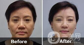 電波拉皮的副作用具體有哪些