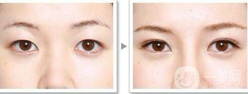 北京割雙眼皮的價格是多少錢