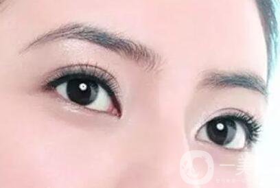 割雙眼皮痕跡多久消失？