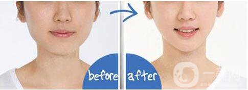 吸脂去雙下巴,吸脂去雙下巴*果,吸脂去雙下巴術(shù)后護(hù)理