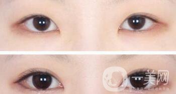 開眼角的后遺癥一般有哪些