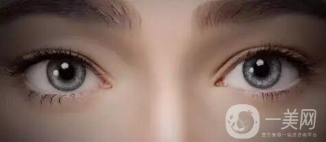 開眼角手術(shù)價(jià)格是多少？