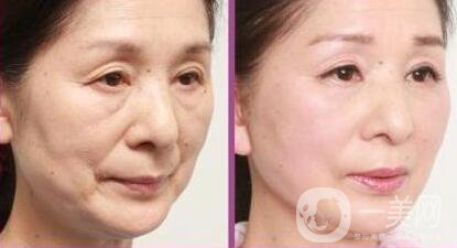 冰點(diǎn)拉皮*果怎么樣？