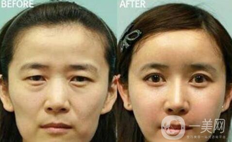 冰點(diǎn)拉皮*果怎么樣？