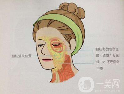 電波拉皮除皺*果好嗎？