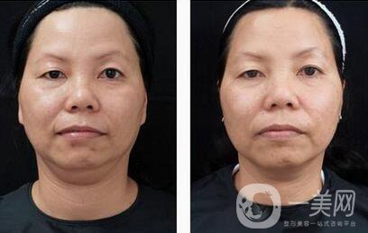 拉皮手術(shù)有些什么副作用