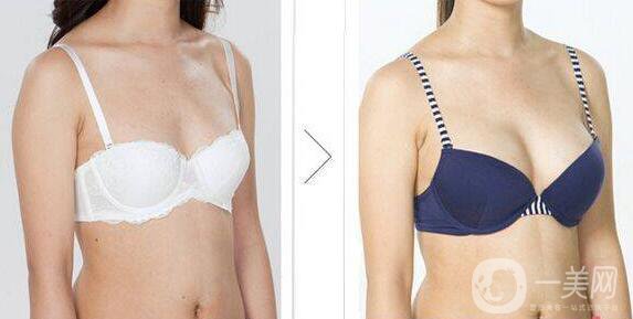 寧波做假體豐胸要多少錢