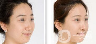 長雙下巴怎么辦？減雙下巴的方法有哪些