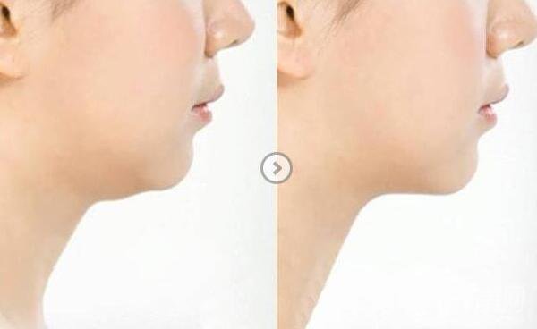 長雙下巴怎么辦？減雙下巴的方法有哪些