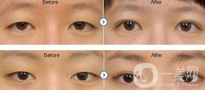重慶埋線割雙眼皮多少錢