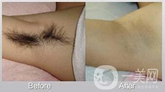 北京激光脫毛的價(jià)格到底是多少