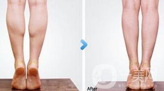 廣州注射*一針多少錢