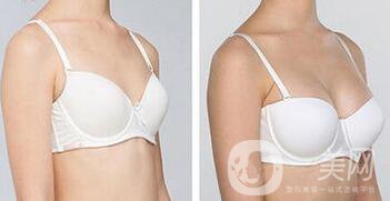 正規(guī)醫(yī)院做假體豐胸多少錢(qián)