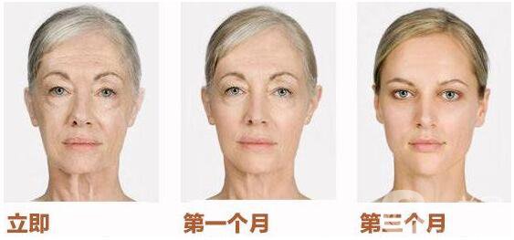 拉皮手術(shù)多少錢(qián),北京臉部拉皮手術(shù)多少錢(qián)