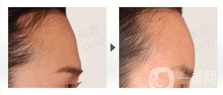 北京豐額頭整形手術(shù)多少錢