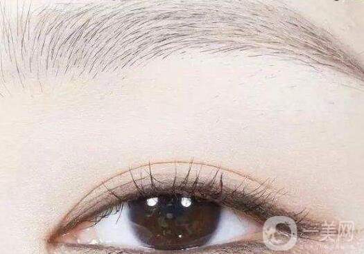 割雙眼皮術(shù),雙眼皮術(shù)后注意事項