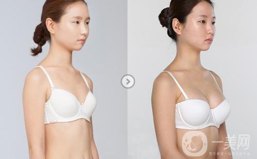 假體隆胸的*果是*性的嗎 術(shù)前需要注意些什么