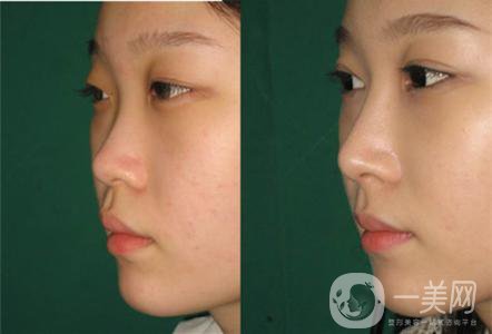 自體脂肪填充墊山根整形方式的危害主要有哪些