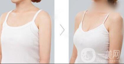 假體豐胸的*性高嗎