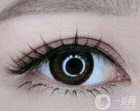 割雙眼皮怎樣可以快速消腫？