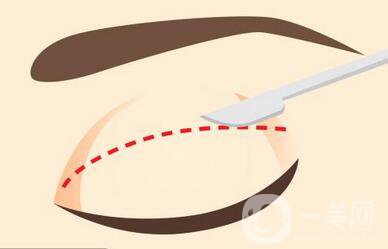 割雙眼皮手術(shù)后如何消腫更快