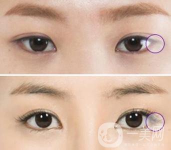 開(kāi)眼角手術(shù)的風(fēng)險(xiǎn)主要有哪些