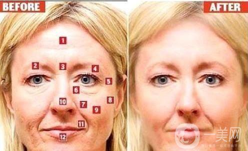 極線音波拉皮手術的價格一般是多少