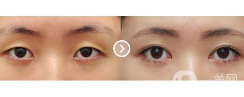 割雙眼皮術(shù)后護(hù)理注意事項(xiàng)有哪些