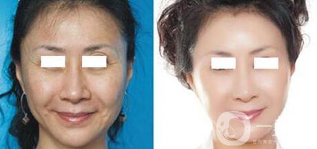 武漢電波拉皮的價錢是多少