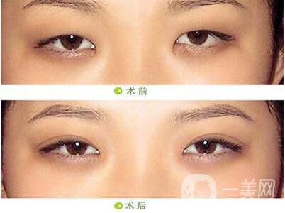 北京開(kāi)眼角,開(kāi)眼角介紹