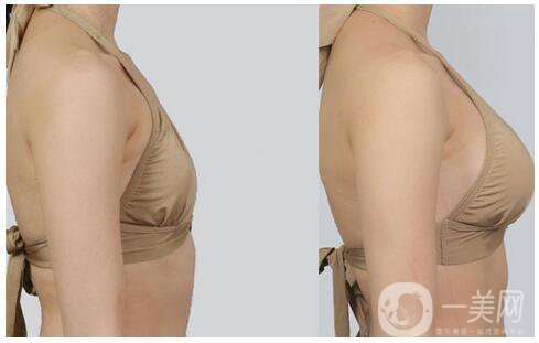 假體豐胸術(shù)后側(cè)睡好不好呢 還有什么需要注意的