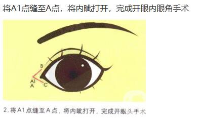 什么是開眼角手術(shù) 術(shù)后如何護(hù)理 3