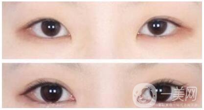 什么是開眼角手術(shù) 術(shù)后如何護(hù)理 4