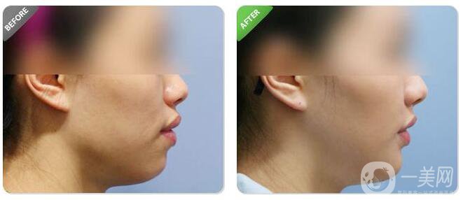 顴骨突出怎么辦 術(shù)后注意事項(xiàng) 2