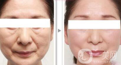 杭州電波拉皮術(shù)需要多少錢