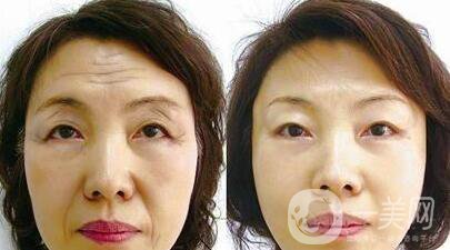 杭州電波拉皮術(shù)需要多少錢