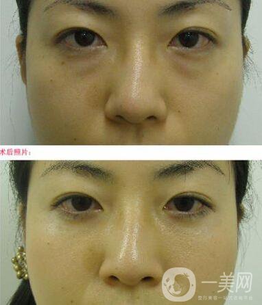 電波拉皮去眼袋*果怎么樣？