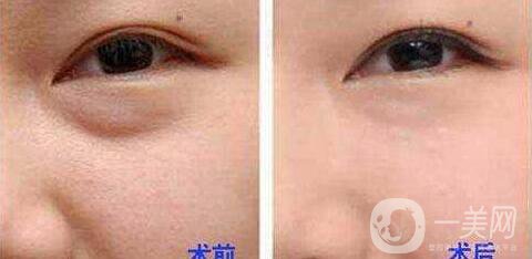 電波拉皮去眼袋*果怎么樣？