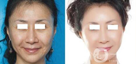 電波拉皮的功*有哪些