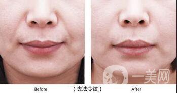 皮膚松弛法令紋熱瑪吉*果嗎