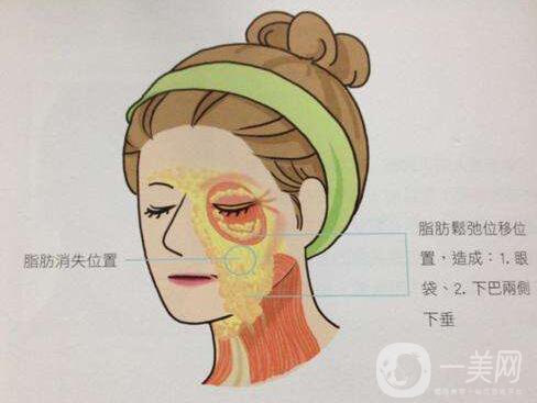 冰電波拉皮好嗎？冰電波拉皮優(yōu)勢！