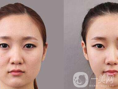 顴骨肉怎么消？怎么縮小顴骨？
