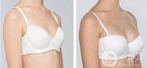 法國(guó)es假體隆胸多少錢(qián),法國(guó)es假體隆胸價(jià)格分析