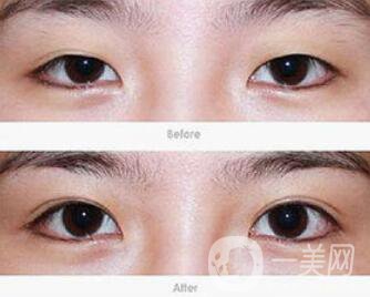 上海開(kāi)眼角價(jià)格是多少