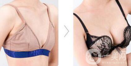 假體隆胸恢復(fù)期要多長時間