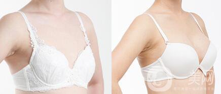 假體隆胸恢復(fù)期要多長時間