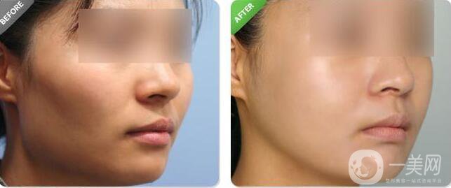 磨顴骨恢復(fù),磨顴骨術(shù)后護(hù)理方式