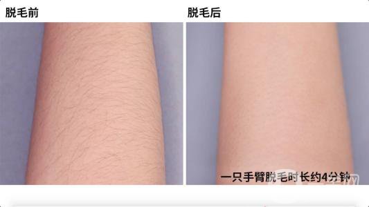 北京激光脫毛一般需要多少錢 術(shù)后怎么護(hù)理